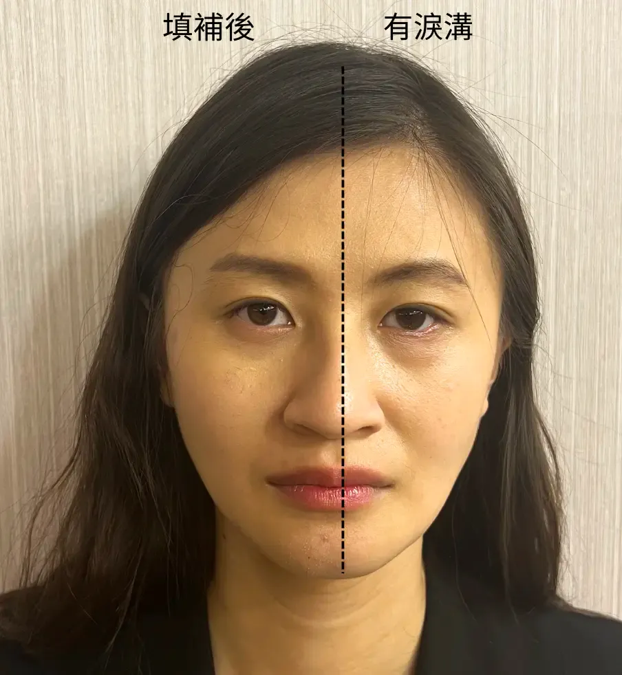 Before and after comparison of tear trough hyaluronic acid: Juvederm Volite superficial layer filling case