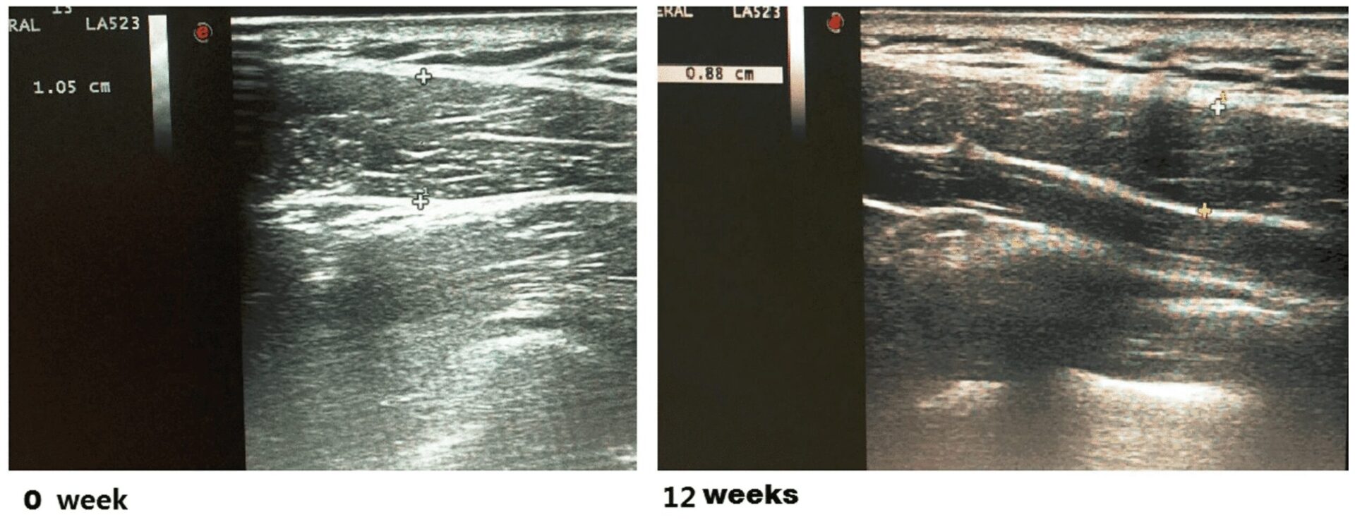 Ultrasound comparison of shoulder botulinum toxin at week 0 and week 12: measuring the change in upper trapezius thickness