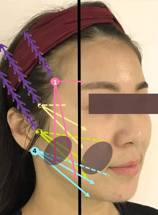 Layered thread lift placement diagram: paths of lifting threads in different directions labeled 1 to 4