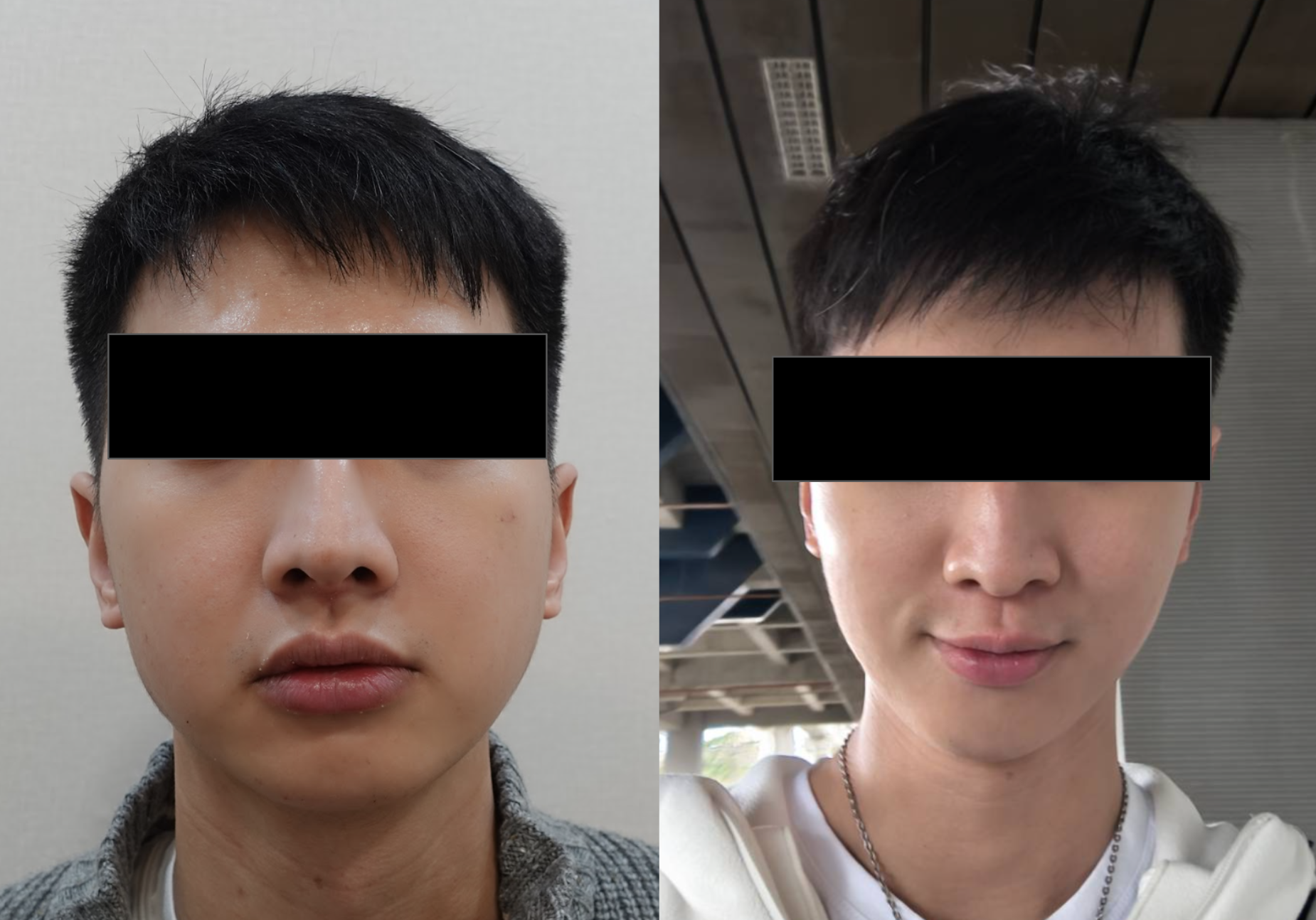Front-view before-and-after comparison of a man who had masseter botulinum toxin, eyes covered