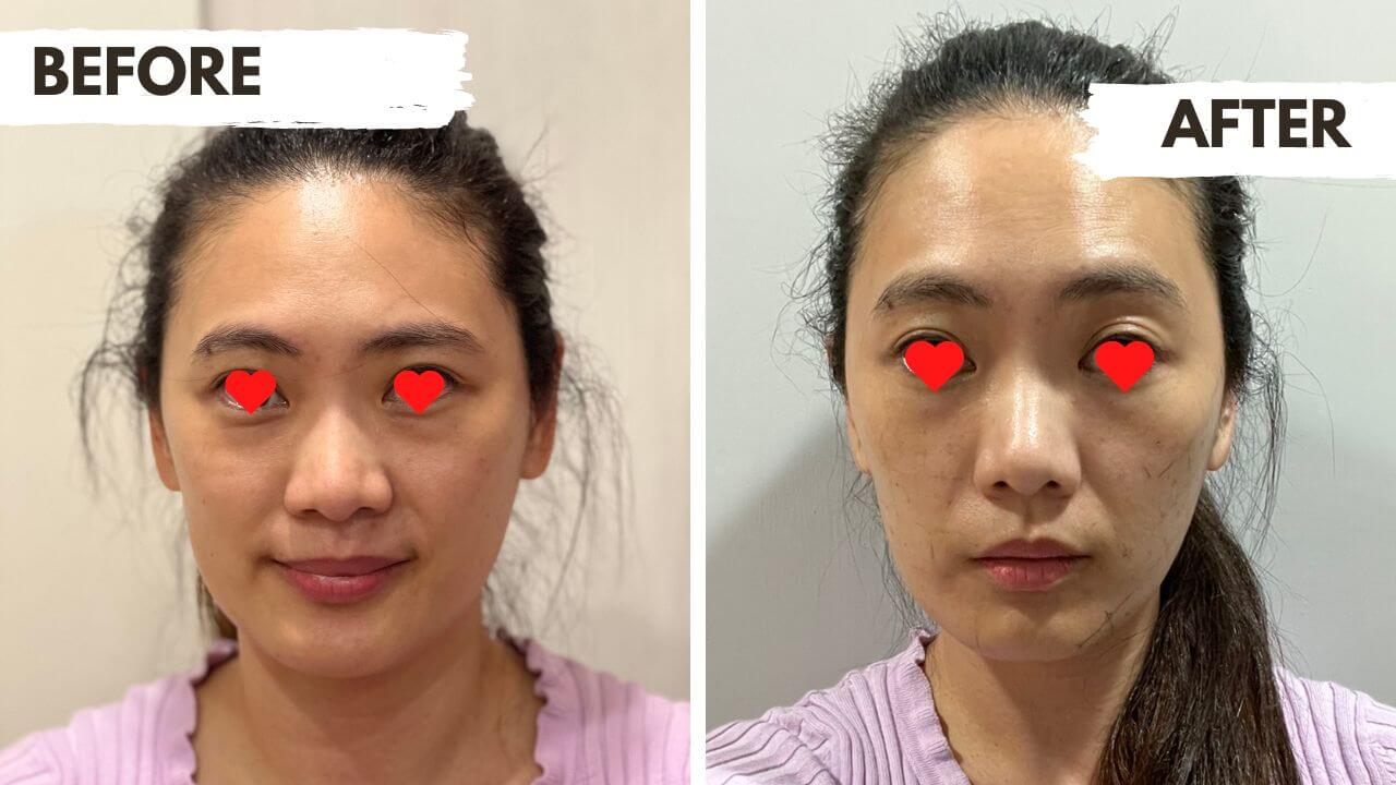Radiofrequency lifting before and after: front-view photos of a woman labeled BEFORE and AFTER