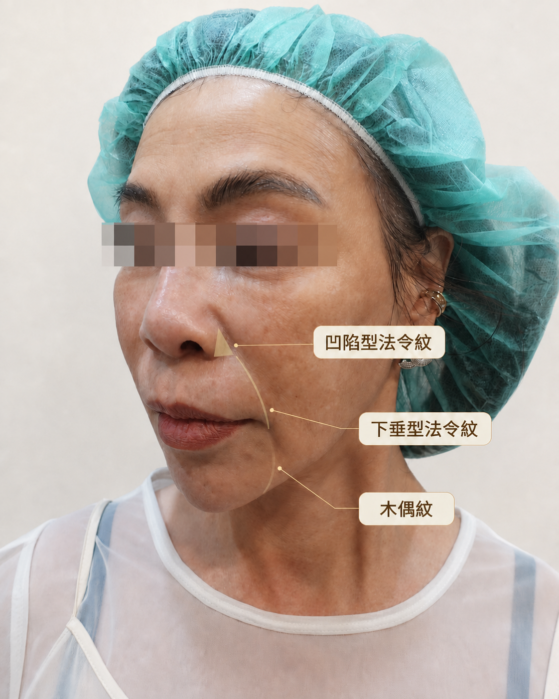 Difference between nasolabial folds and a hollow nasal base