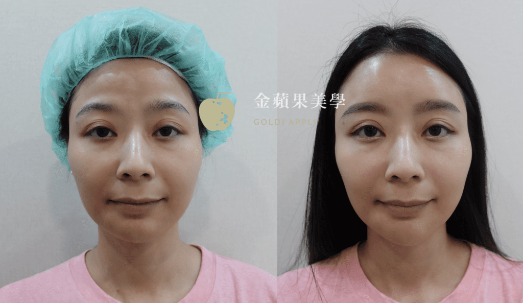 Before-and-after comparison of Ellanse forehead augmentation: the forehead is full and smooth after treatment