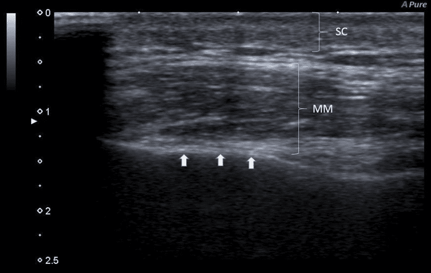 Masseter ultrasound image: subcutaneous layer (SC) and masseter (MM) labelled, arrows pointing to the white line of the mandible