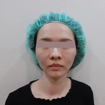 Front-view case photo of a 38-year-old woman whose tear trough formed caterpillars after filler
