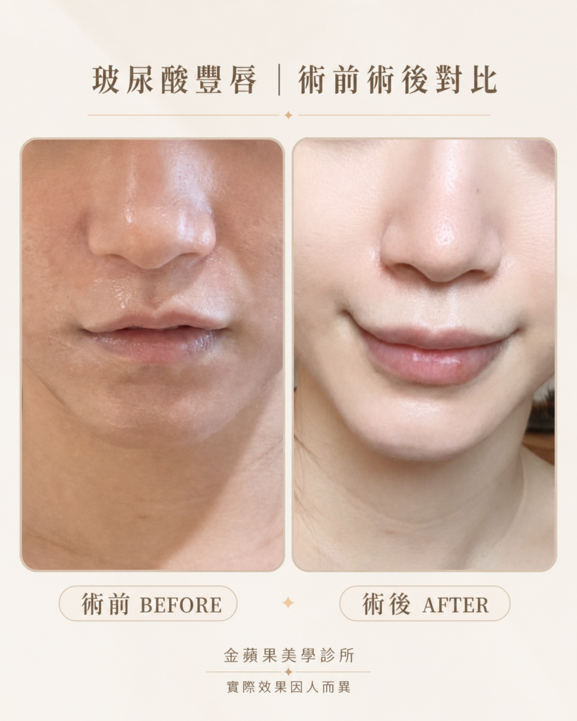 Before and after photos of lip augmentation with Juvederm Volift lip filler, with fuller lips