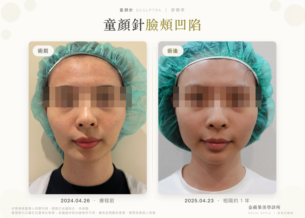 Sculptra for hollow cheeks