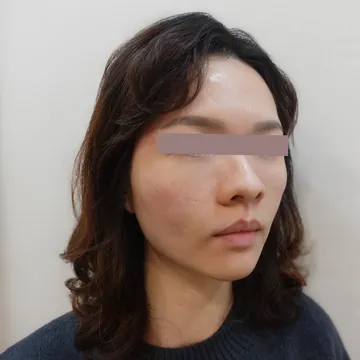 Three-quarter view of a woman with natural-looking tear troughs after re-injecting Juvederm filler following dissolving