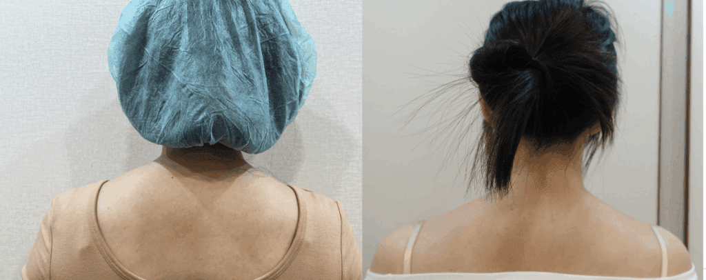 Shoulder botulinum toxin