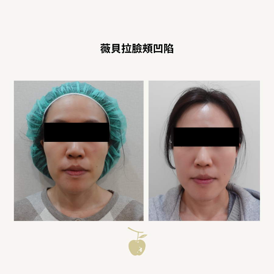 Front-view follow-up comparison of hollow cheeks one year after two vials of Vivabella