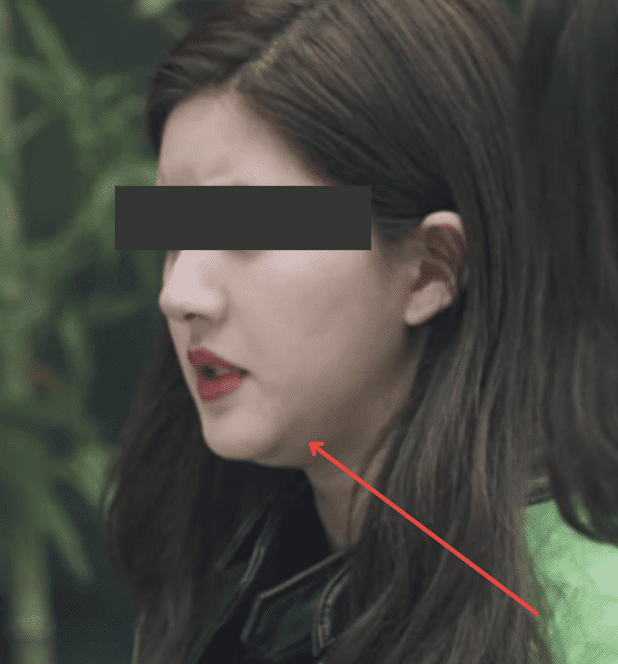 Failed chin hyaluronic acid