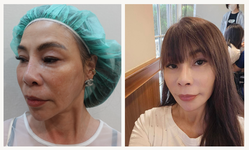 Thread lift case for sagging-type nasolabial folds: before and after comparison of the face