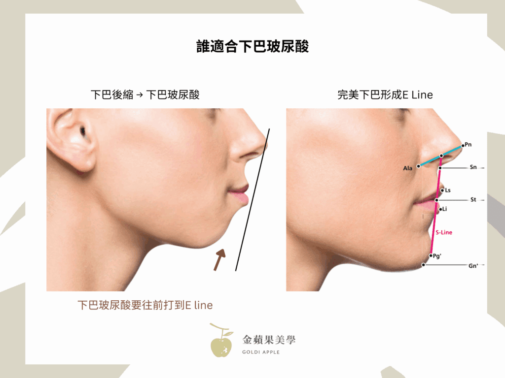 Receding chin