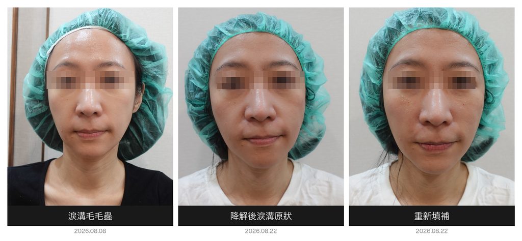 Dissolving tear trough hyaluronic acid