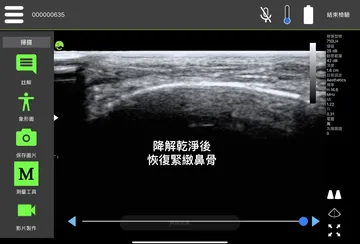 Ultrasound image labeled "firm nasal bone restored after dissolving cleanly"