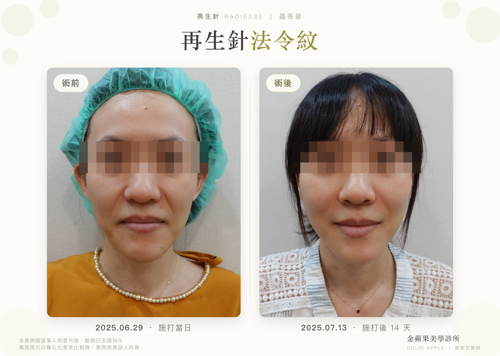 Radiesse nasolabial folds