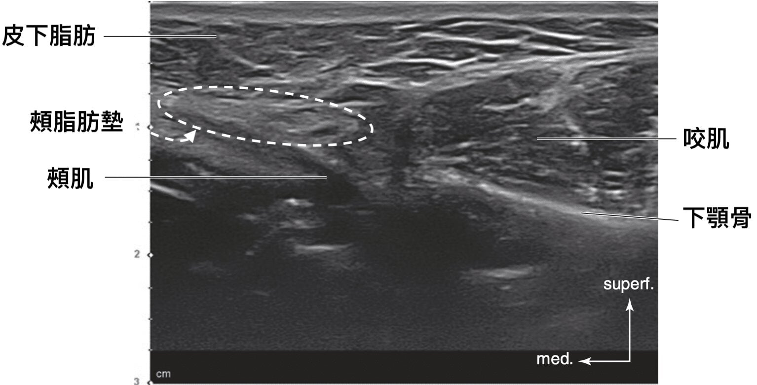 Cheek ultrasound image: labeling the subcutaneous fat, buccal fat pad, buccinator, masseter and mandible