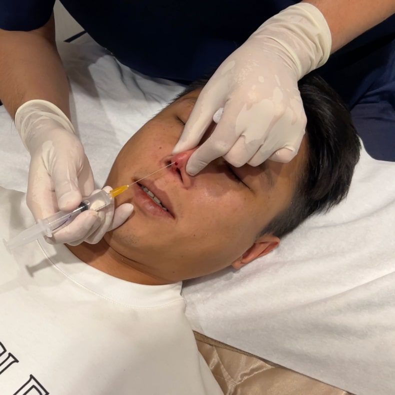 Before the thread rhinoplasty, the doctor injects anesthetic at the nasal tip with a fine needle
