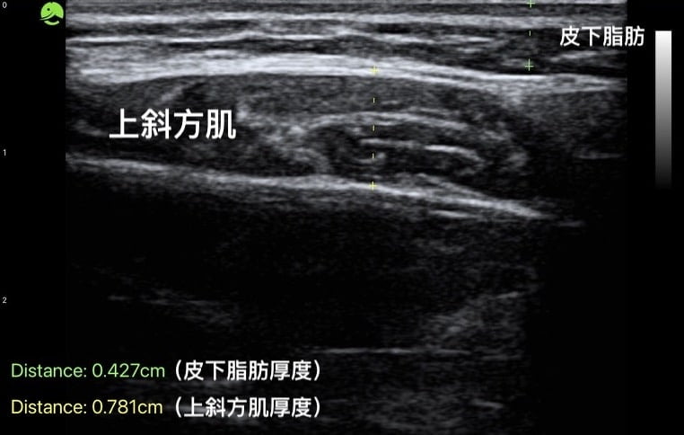 Ultrasound measurement of subcutaneous fat and upper trapezius thickness as a reference for shoulder botulinum toxin injection