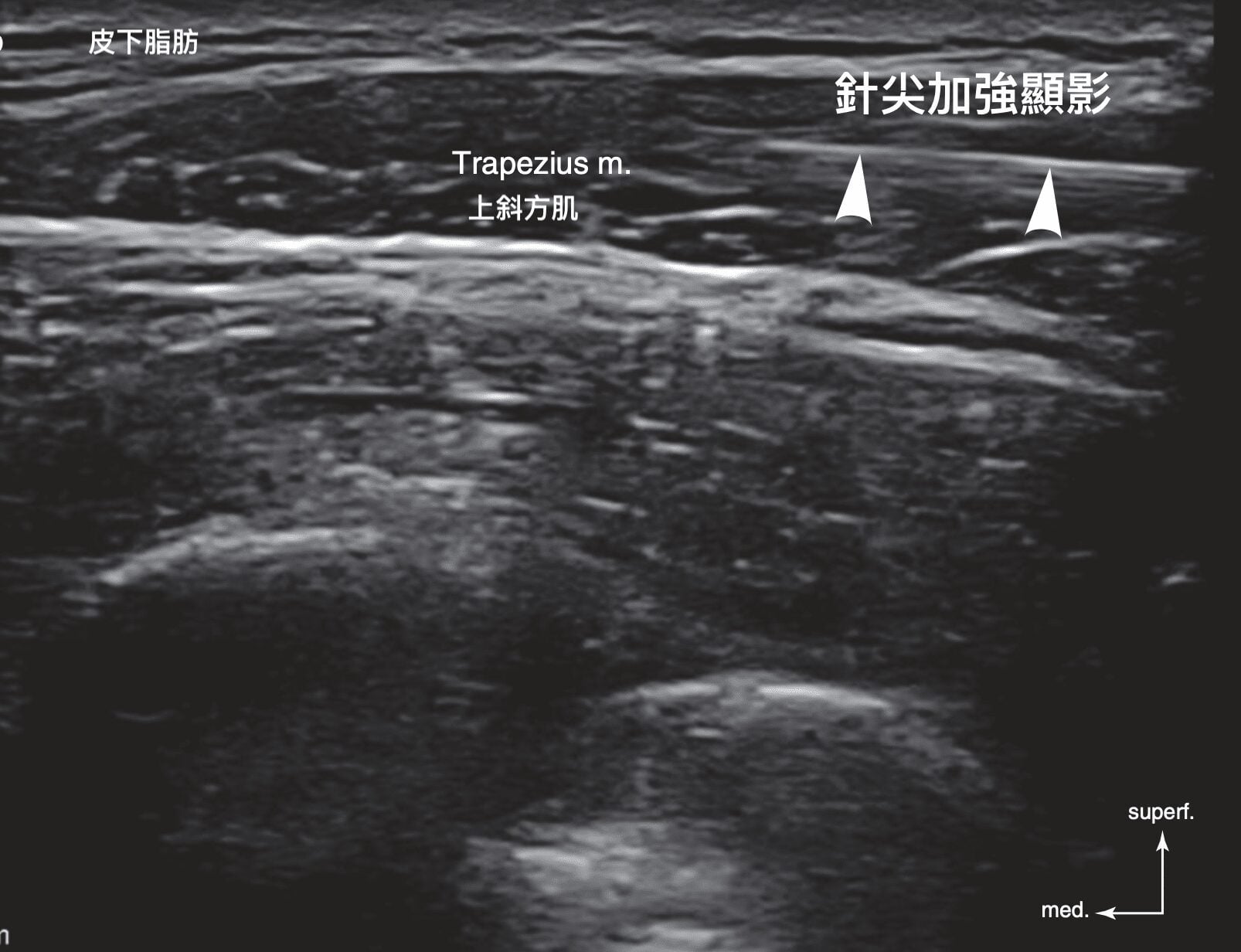 Ultrasound image of shoulder botulinum toxin: the upper trapezius is labeled and the needle tip is enhanced