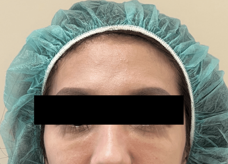 Case of tear trough hyaluronic acid placed in the superficial layer causing an under-eye bulge (commonly called a 'caterpillar')