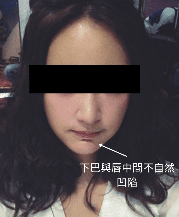 Regretting chin hyaluronic acid