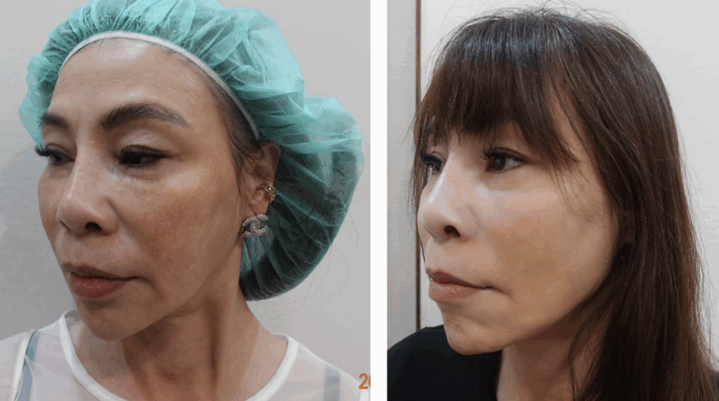 鬆垂型嘴邊肉客人案例對比照,嘴角旁可見木偶紋與嘴邊肉