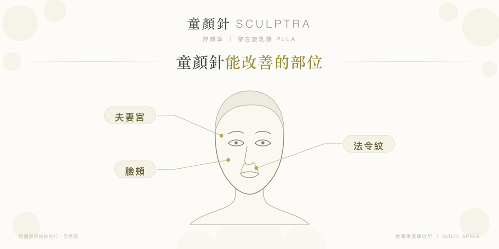 Areas Sculptra improves