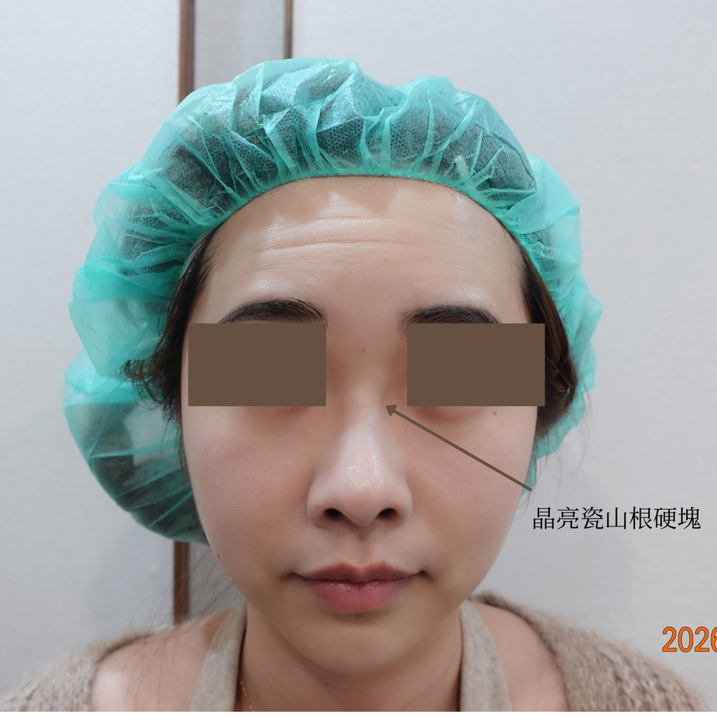 Hard lump in the nose after Radiesse