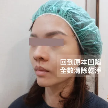 Side-face photo of a woman labeled "back to the original hollow, completely cleared," showing the tear trough after dissolving