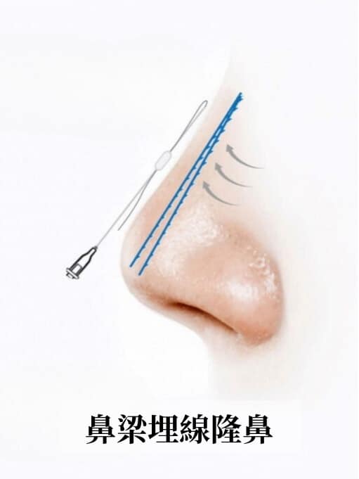 Diagram of 'nasal bridge thread rhinoplasty': a cannula places barbed threads along the nasal bridge to lift the nose