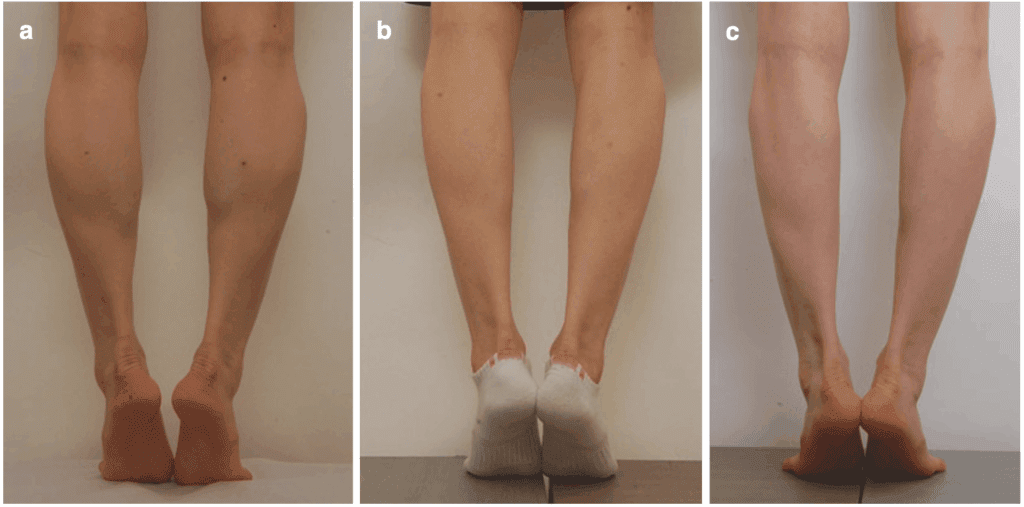 Calf botulinum toxin