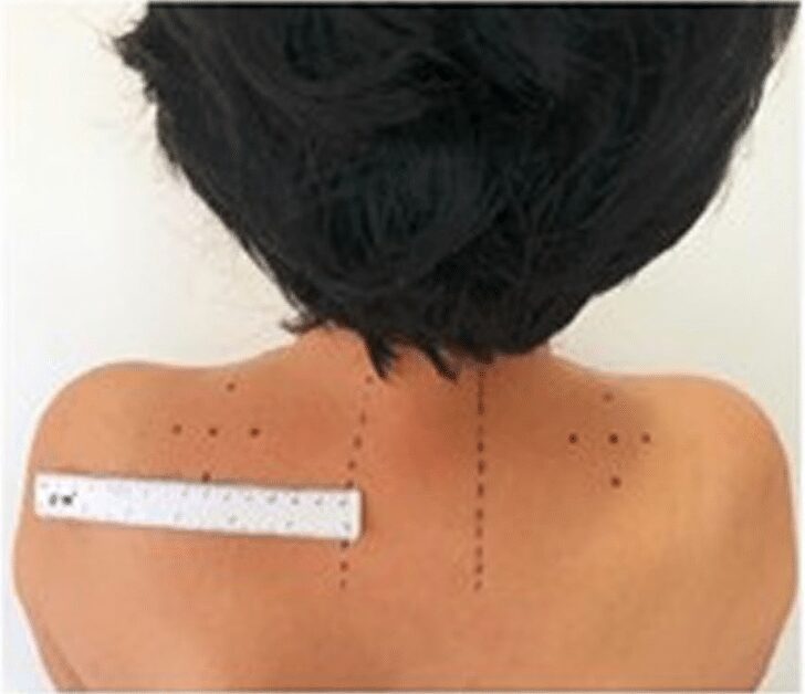 Shoulder botulinum toxin