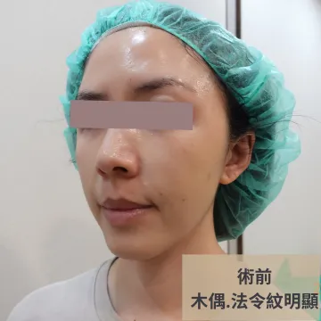 Pre-treatment three-quarter view photo of a thread lift, labeled "Before: obvious marionette lines and nasolabial folds"