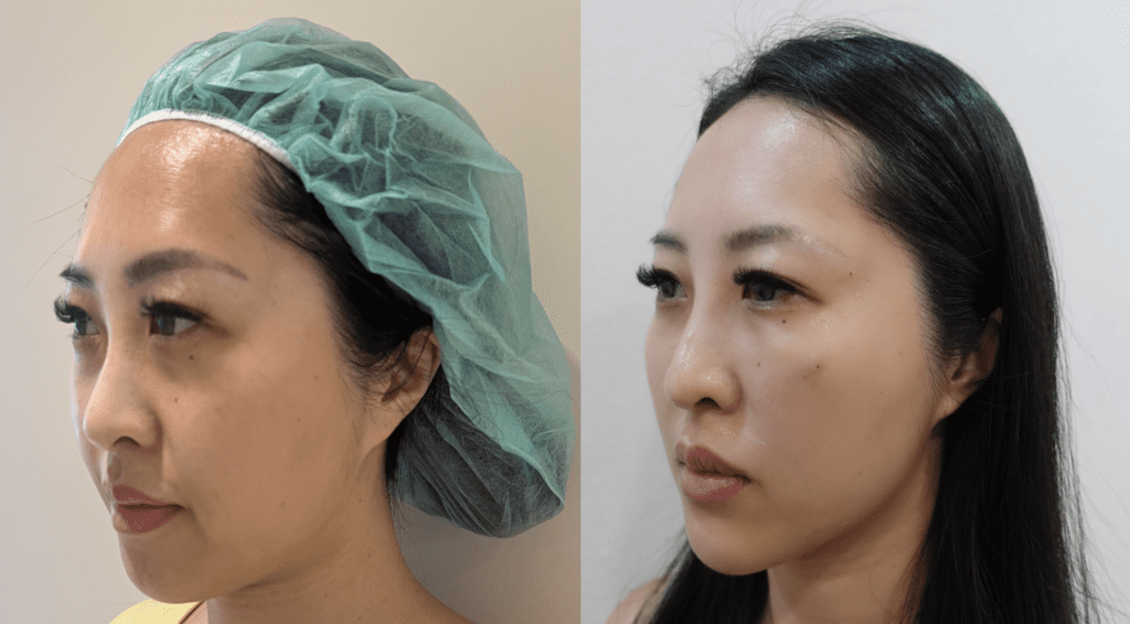 Nose thread lift