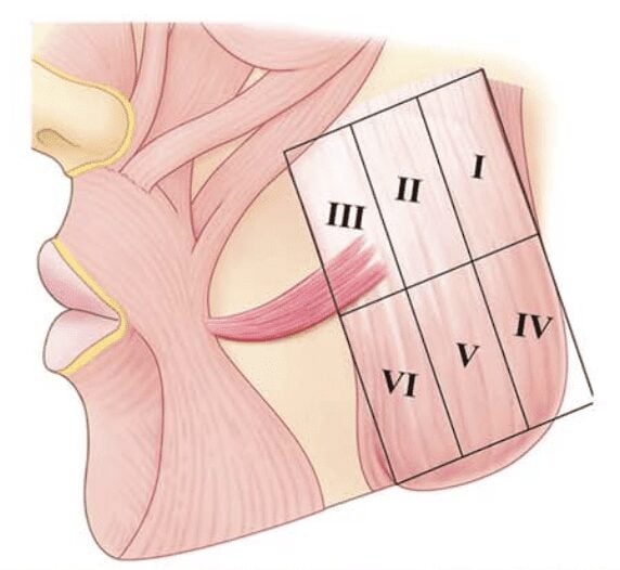 Diagram of masseter botulinum toxin injection zones: the masseter divided into six areas, I to VI