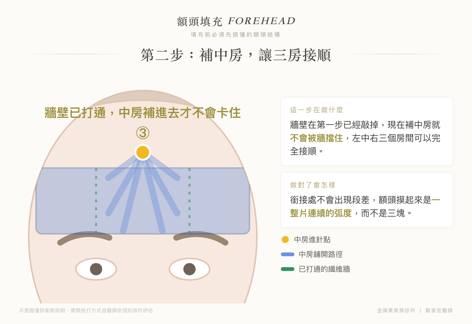 Illustration of step two of forehead filling: after the walls are opened, fill the middle room so the left, middle and right rooms join smoothly without steps
