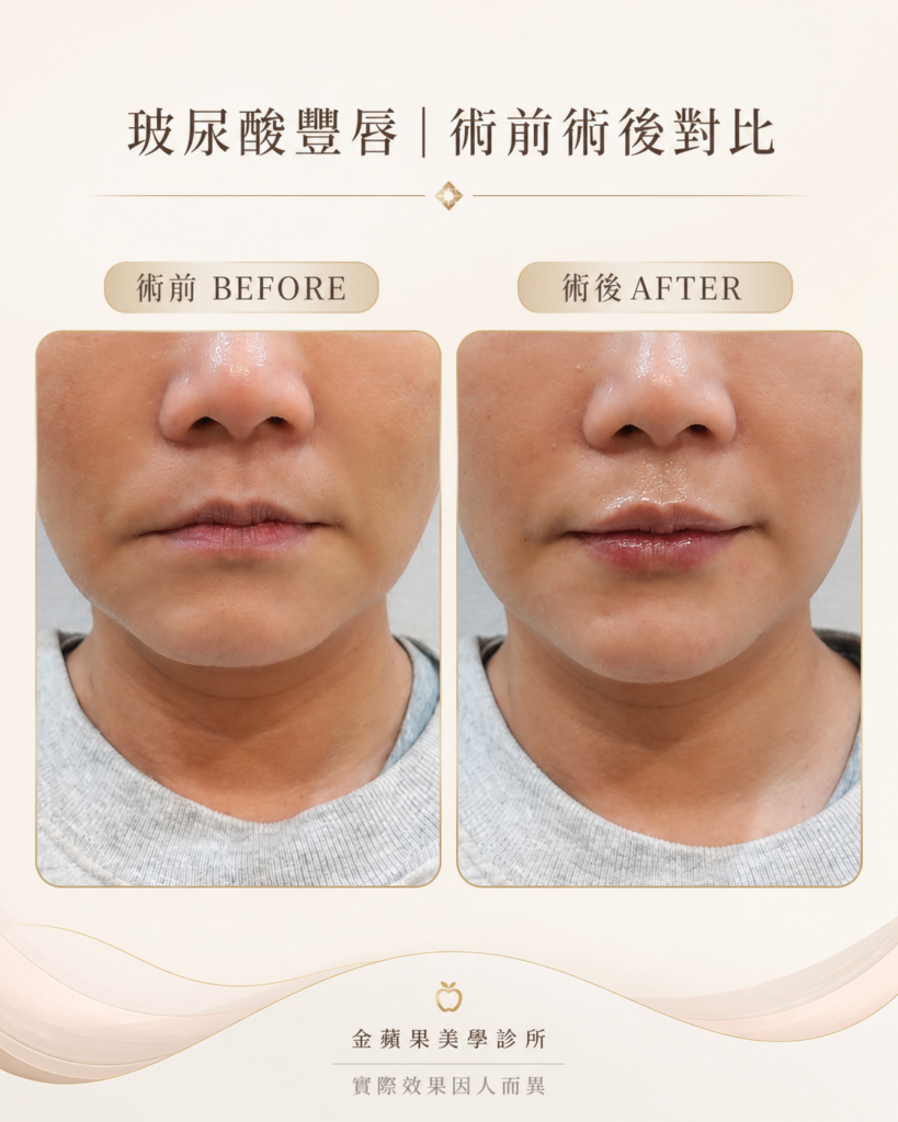 Before and after photos of Juvederm Vobella lip filler, mainly increasing lower lip thickness