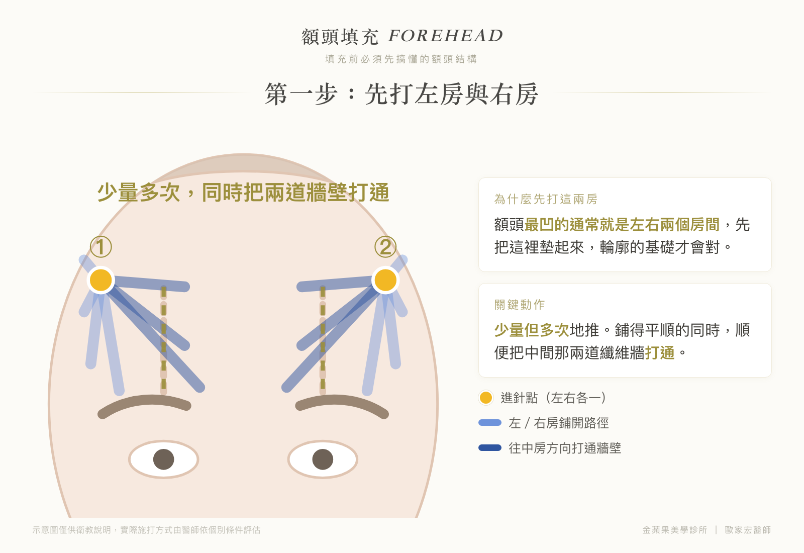 Illustration of step one of forehead filling: two entry points on the left and right, spreading the left and right rooms in small amounts over several passes while opening up both fibrous walls