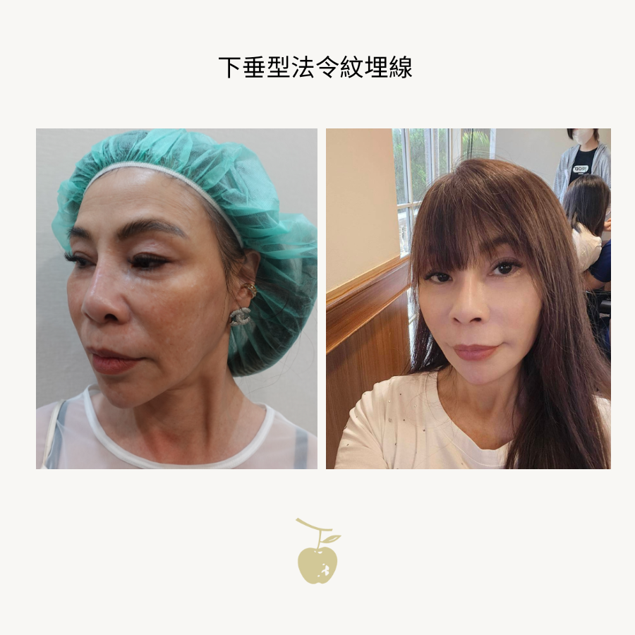 Sagging-type nasolabial fold thread lift case: before and after comparison photos