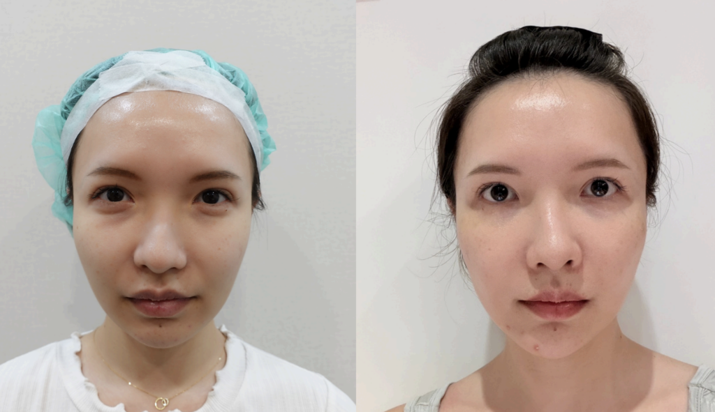 Thread lift result