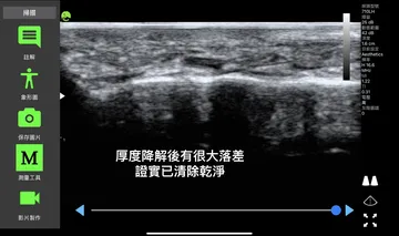 Ultrasound image labeled "big difference in thickness after dissolving, confirming it has been cleared"
