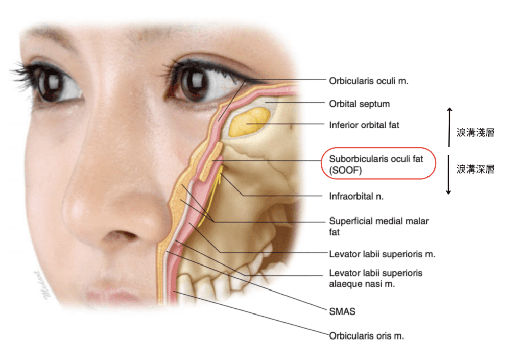Diagram of the deep and superficial injection layers for tear trough hyaluronic acid