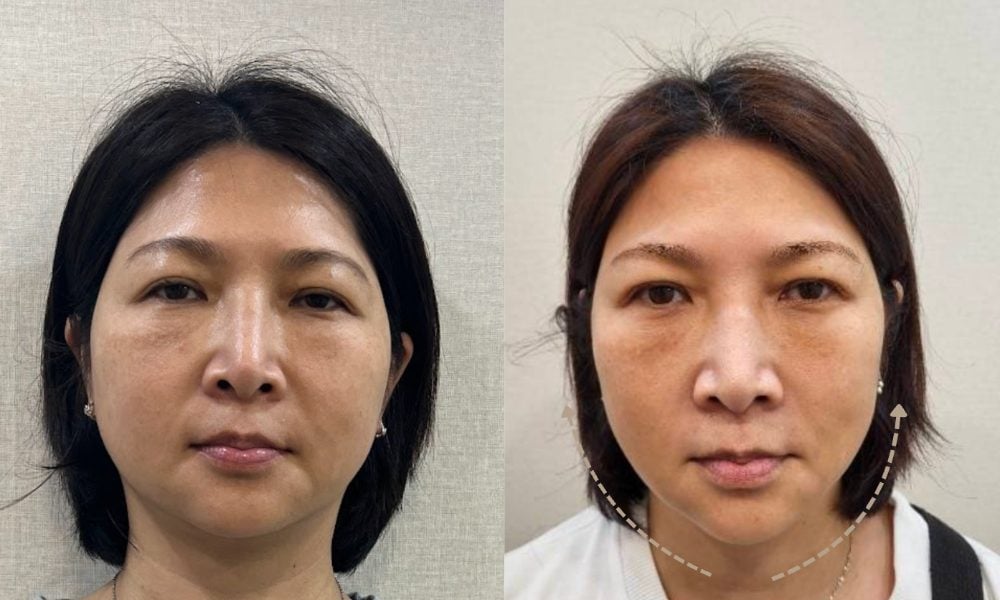 金蘋果美學診所|消除嘴邊肉案例二