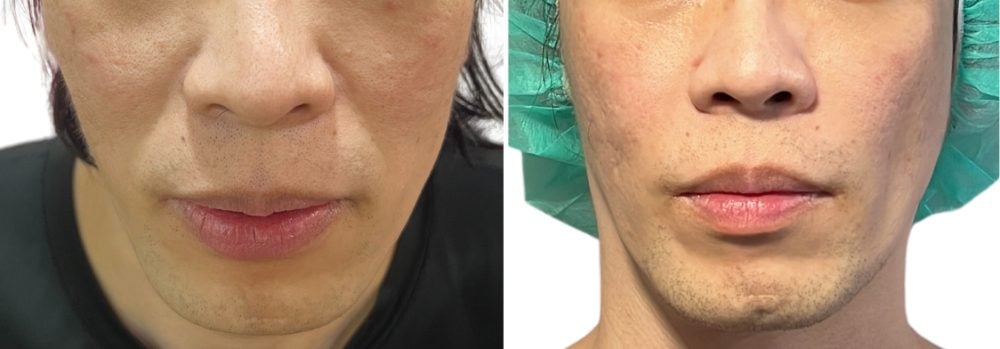 Golden Apple Aesthetic Clinic | Nasolabial fold treatment case 2