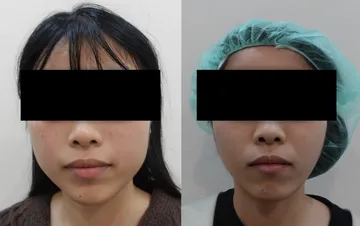 Front-view before-and-after comparison of a woman who had masseter botulinum toxin