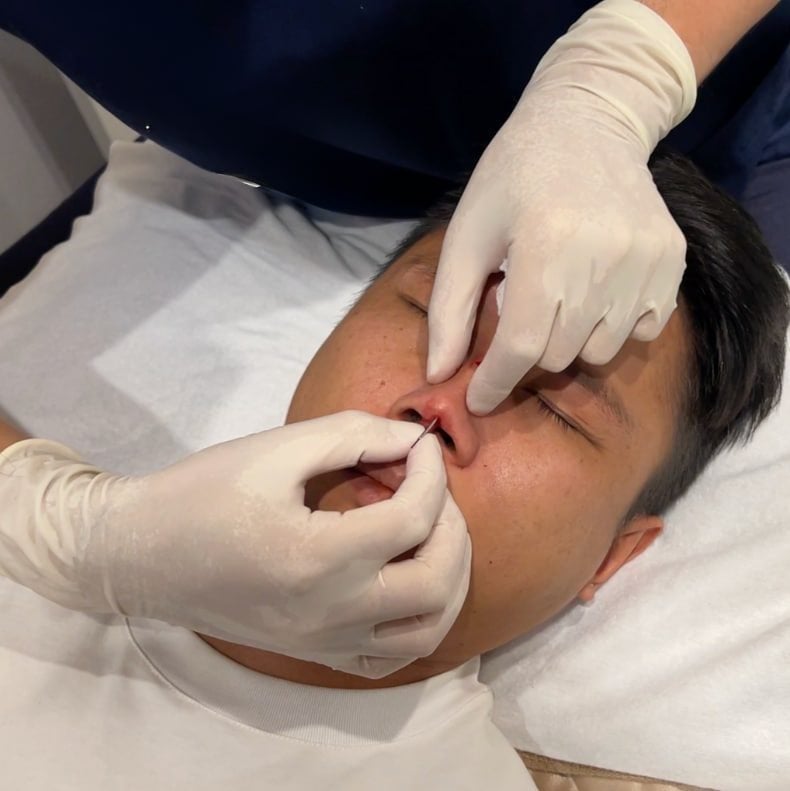 Photo of the doctor's hands placing nose thread lift threads at the center of the nasal bridge