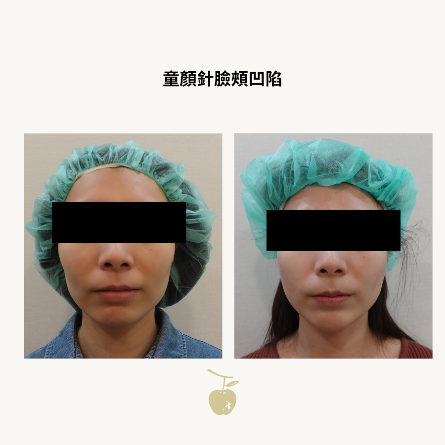 Front-view comparison of hollow cheeks four months after one vial of Sculptra