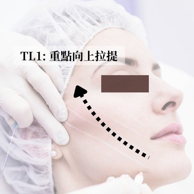 TL1 key upward lift diagram: arrows show the upward lifting direction of the cheek threads
