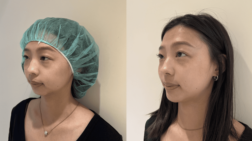 EPTQ honeycomb hyaluronic acid chin